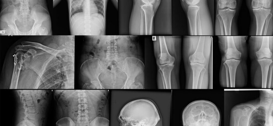 Bones &#8211; structure, types, functions and diseases [EXPLAINED]