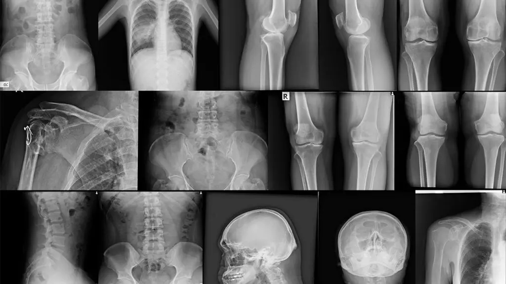 Bones &#8211; structure, types, functions and diseases [EXPLAINED]