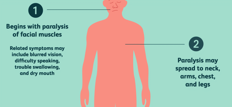 Botulinum toxin infection. How is botulism treated?