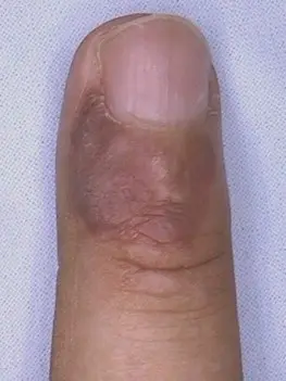 Bowen&#8217;s disease in the distal phalanges
