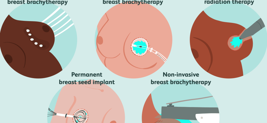 Brachytherapy &#8211; types, indications, preparation, course, benefits and side effects