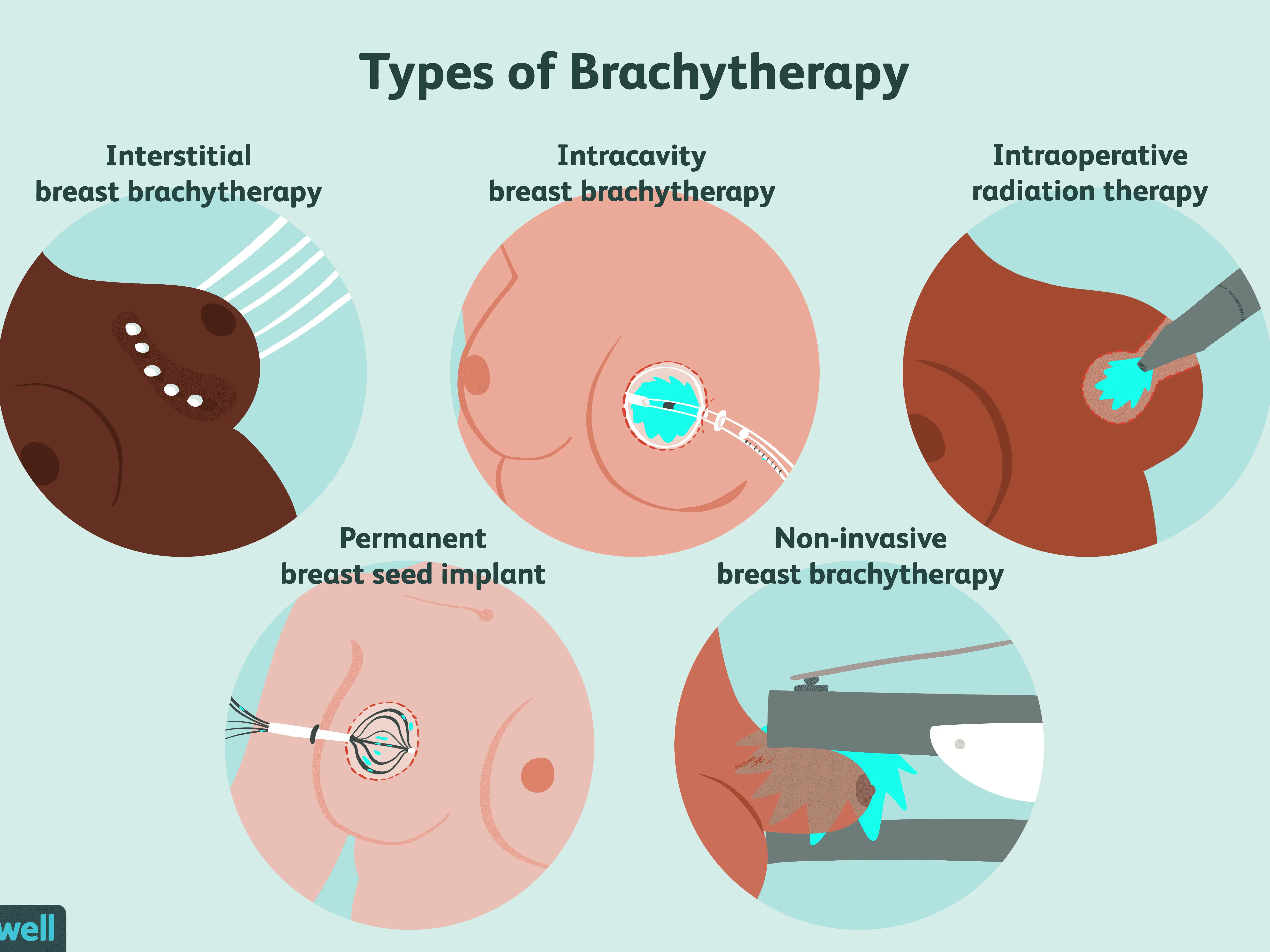 Brachytherapy &#8211; types, indications, preparation, course, benefits and side effects