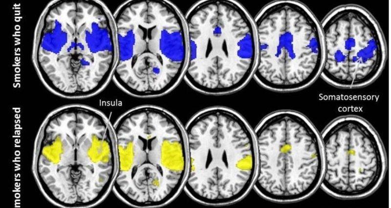 Brain activity can predict success in quitting smoking