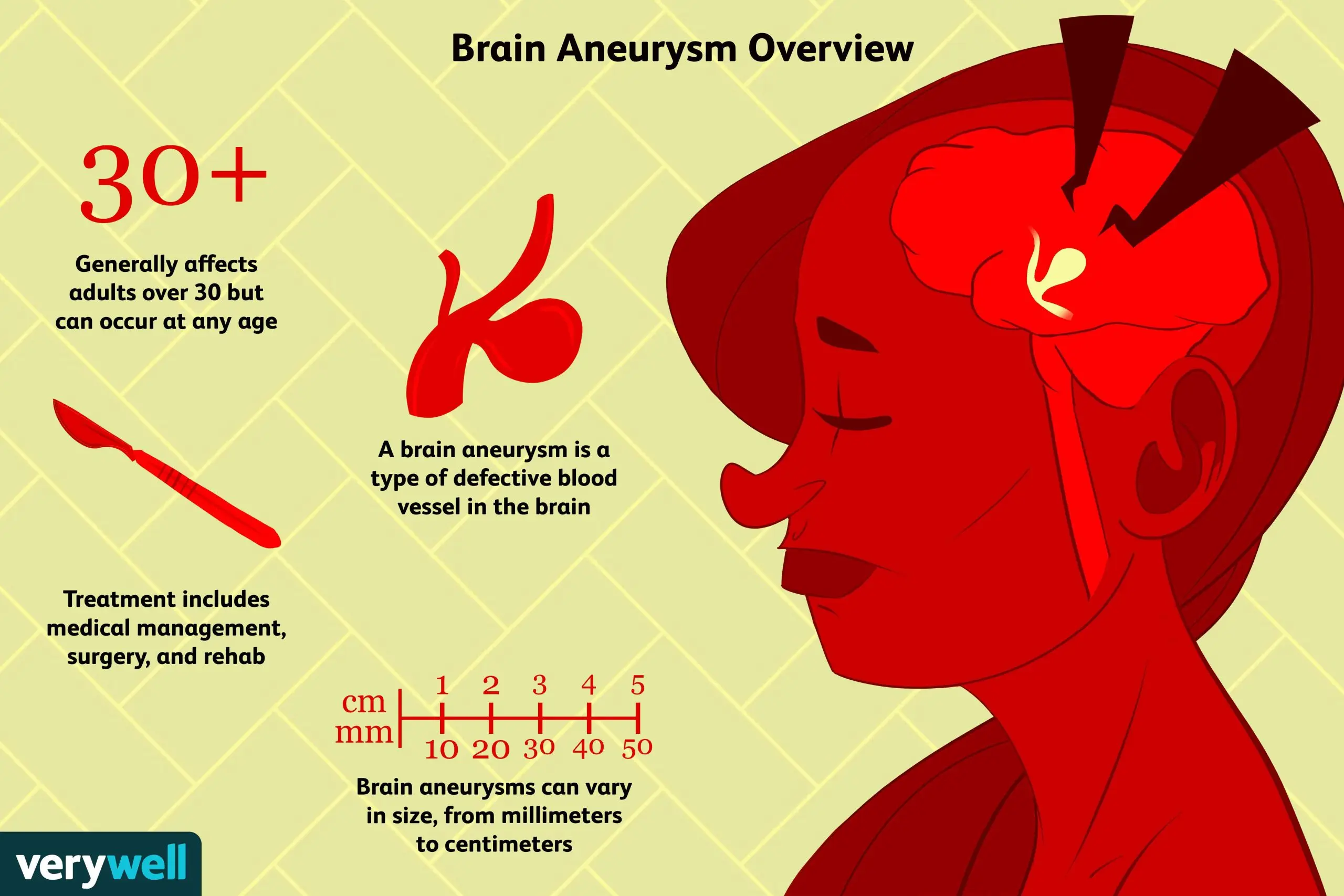 Brain aneurysm. How is it recognized and treated?