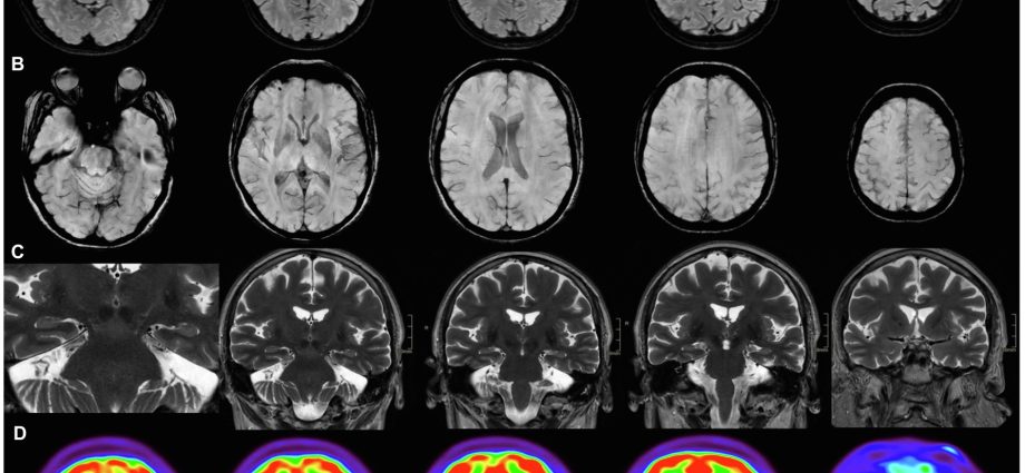 Brain fog after COVID-19. How to fight it? Explains the neurologist