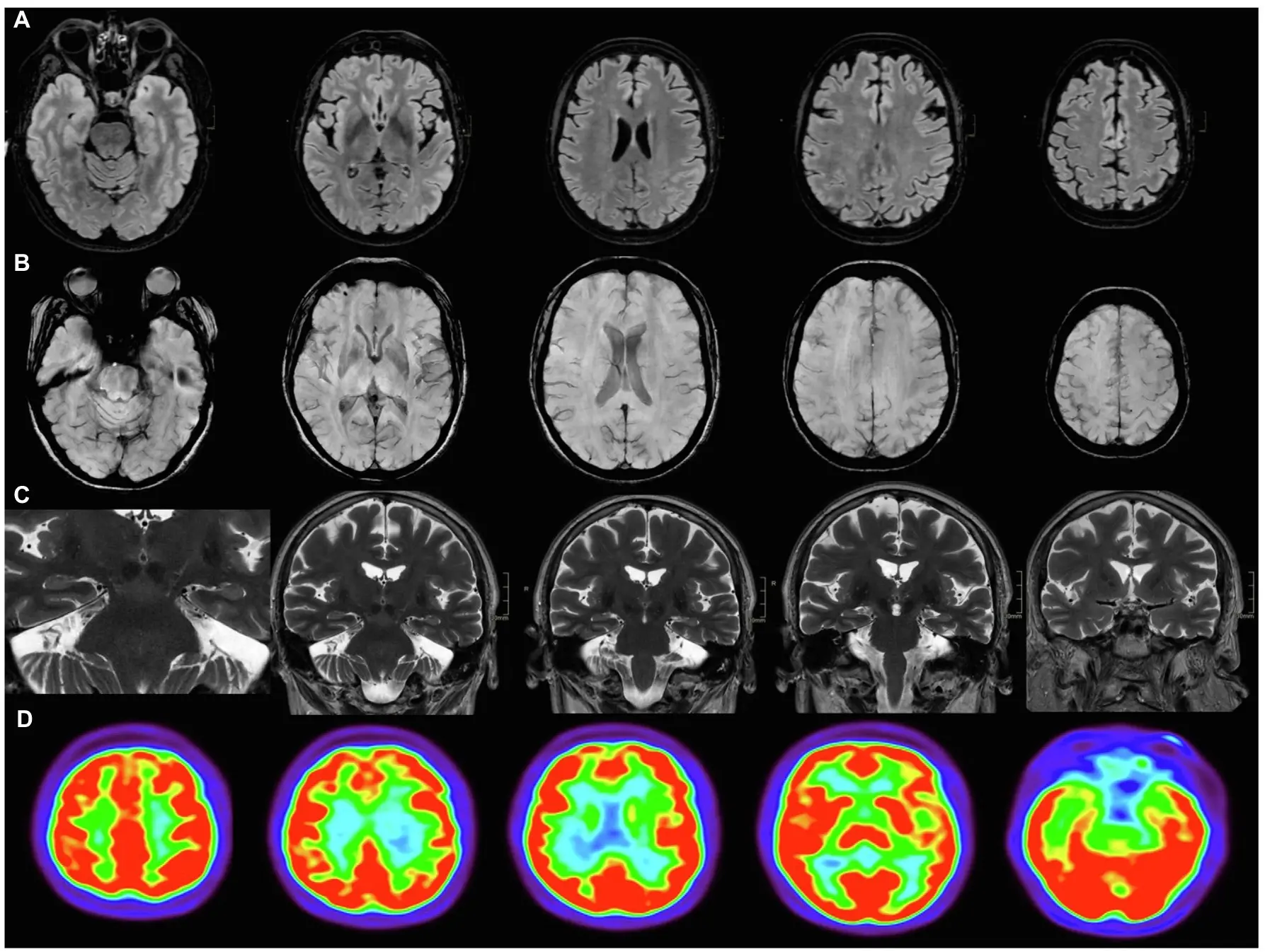 Brain fog after COVID-19. How to fight it? Explains the neurologist