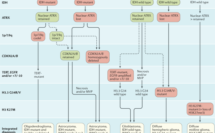 Brain glioma &#8211; symptoms, treatment, prognosis