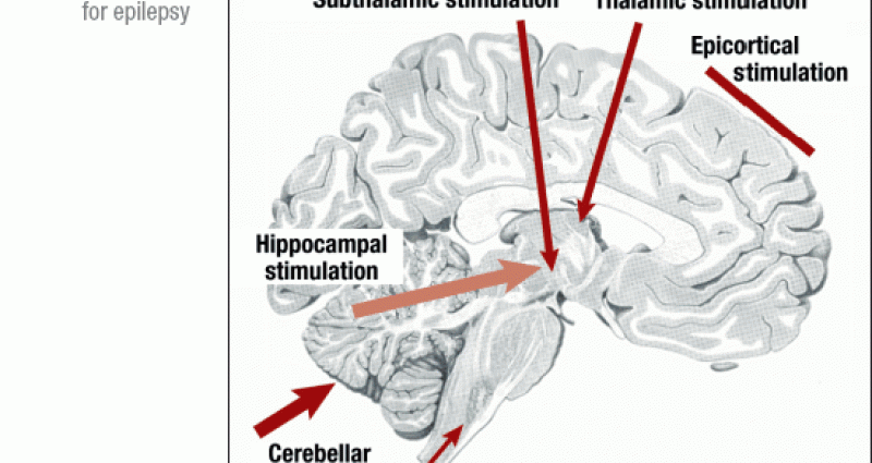 Brain stimulation can treat epilepsy