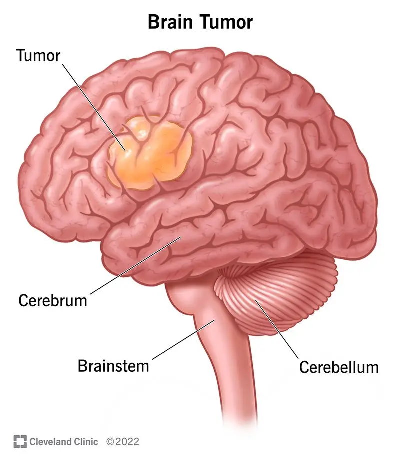 Brain tumor &#8211; is there a chance to treat a brain tumor?