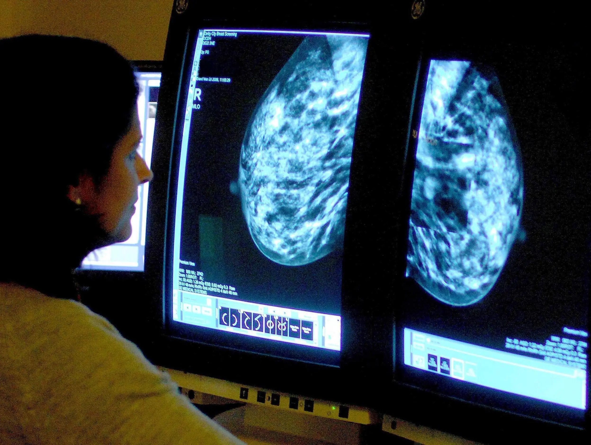 Breakthrough in the treatment of breast cancer? US scientists have good news