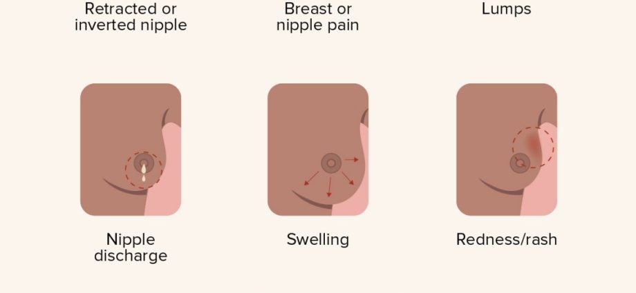 Breast cancer. How to recognize the early symptoms of the disease?