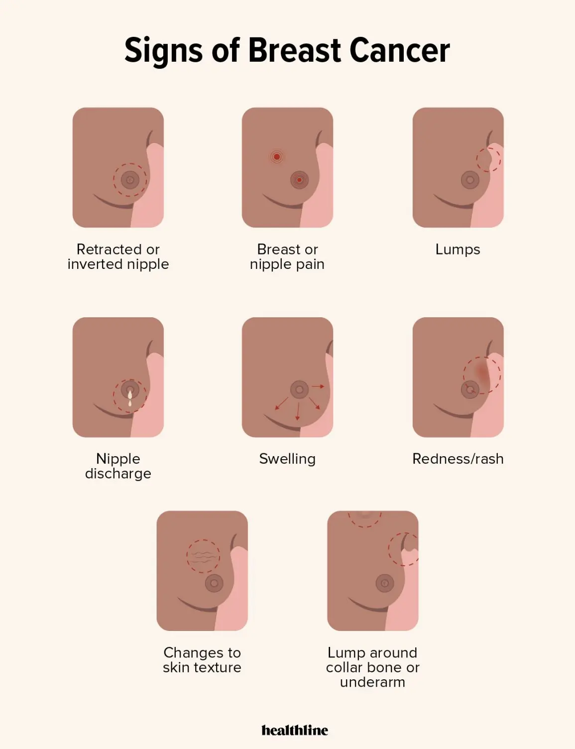 Breast cancer. How to recognize the early symptoms of the disease?