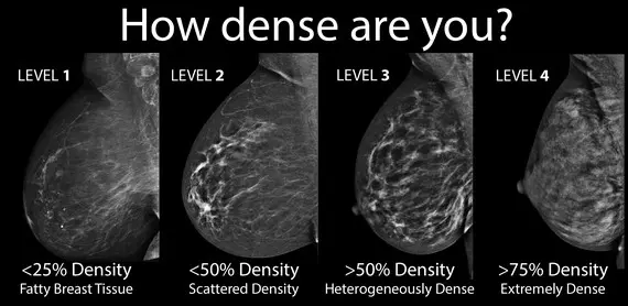 Breast ultrasound is much more effective than mammography in women with high breast density