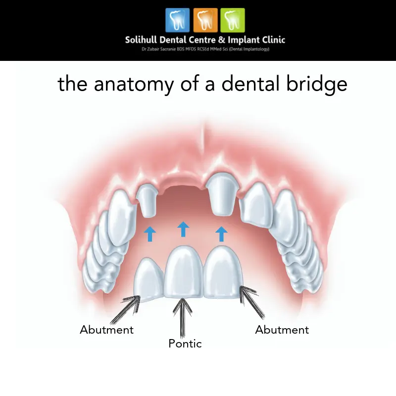 Bridges on implants &#8211; characteristics, course of the procedure, durability