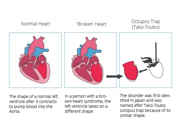 Broken heart syndrome, aka Takotsubo syndrome