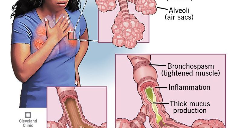 Bronchial asthma &#8211; causes, symptoms, treatment. Management of an attack of bronchial asthma