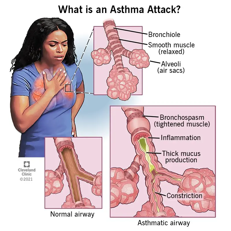 Bronchial asthma &#8211; causes, symptoms, treatment. Management of an attack of bronchial asthma