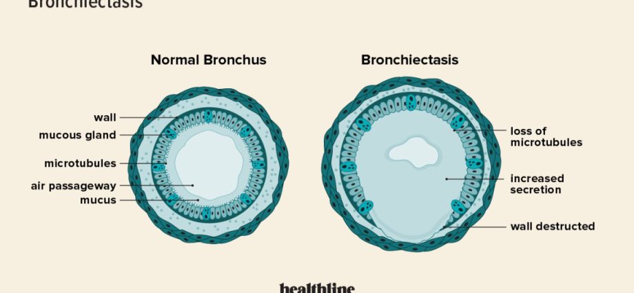 Bronchiectasis &#8211; treatment, symptoms, causes and prognosis