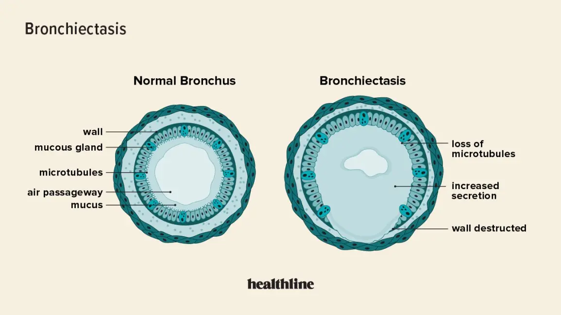 Bronchiectasis &#8211; treatment, symptoms, causes and prognosis