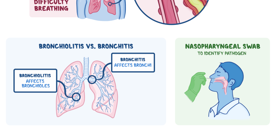 Bronchiolitis &#8211; causes, symptoms, treatment, complications