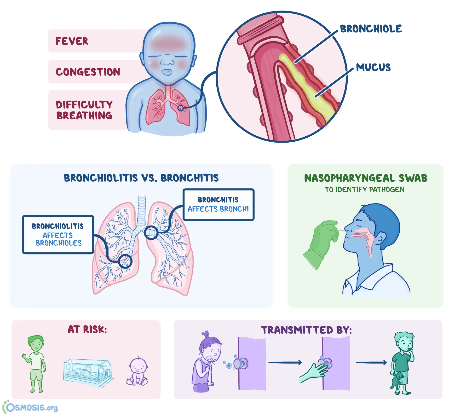 Bronchiolitis &#8211; causes, symptoms, treatment, complications