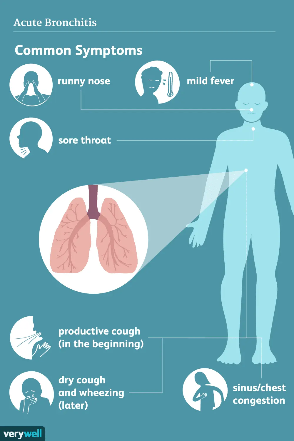 Bronchitis &#8211; symptoms, types, treatment, complications [EXPLAINED]