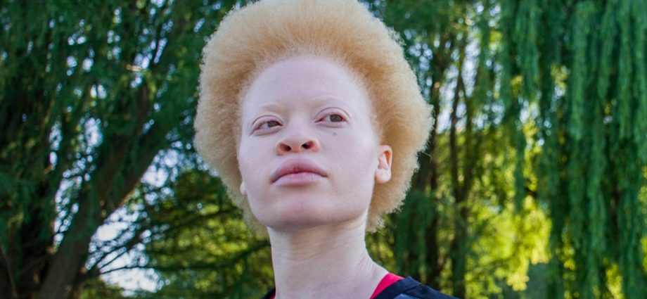 Brown and red albinism &#8211; what is it?