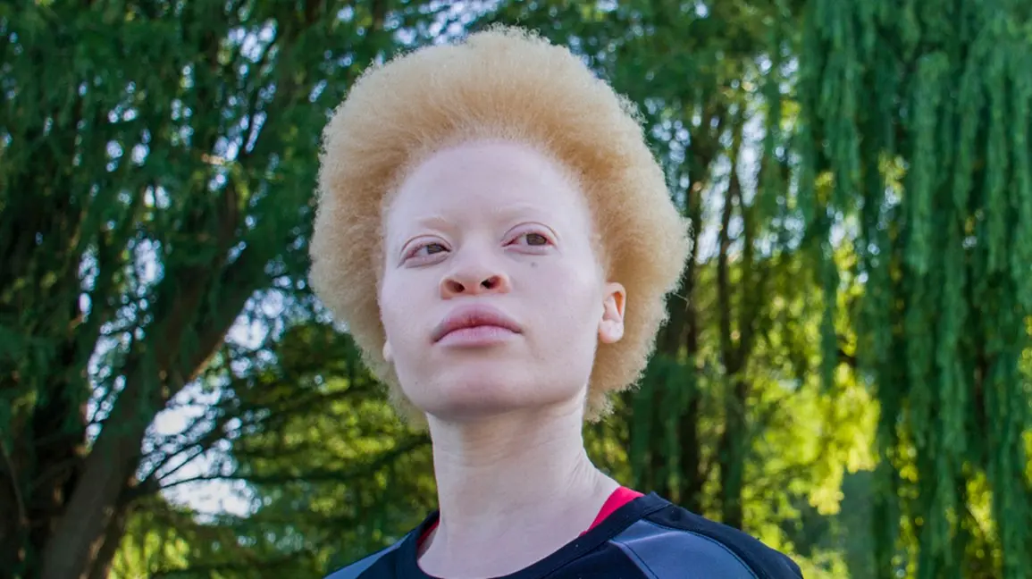 Brown and red albinism &#8211; what is it?