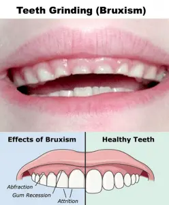 Bruxism &#8211; night teeth grinding