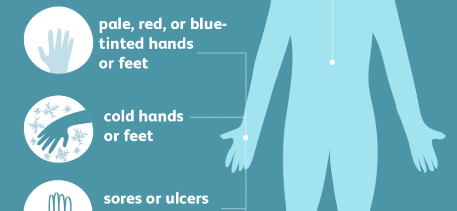 Buerger&#8217;s disease &#8211; causes, first symptoms and treatment