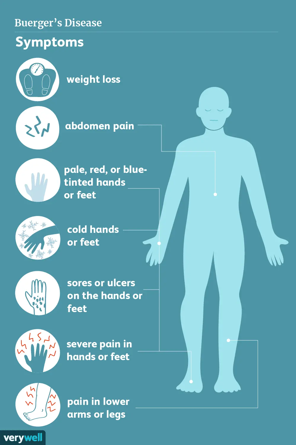 Buerger&#8217;s disease &#8211; causes, first symptoms and treatment