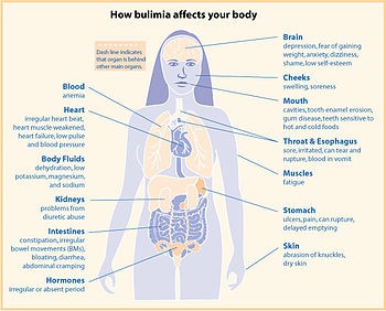 Bulimia nervosa &#8211; causes, symptoms, treatment and consequences. What is this?