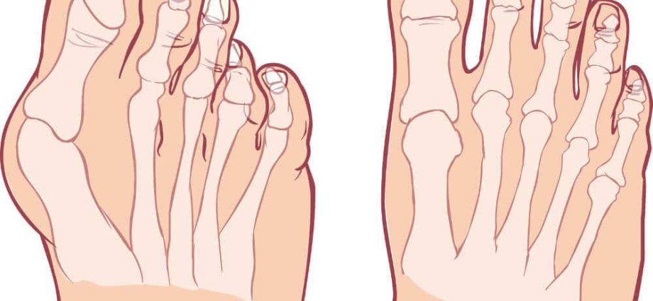 Bunions and hammer fingers &#8211; a lopsided problem