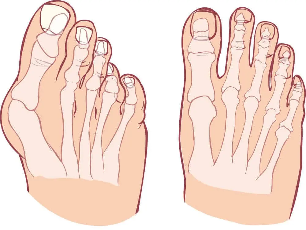 Bunions and hammer fingers &#8211; a lopsided problem