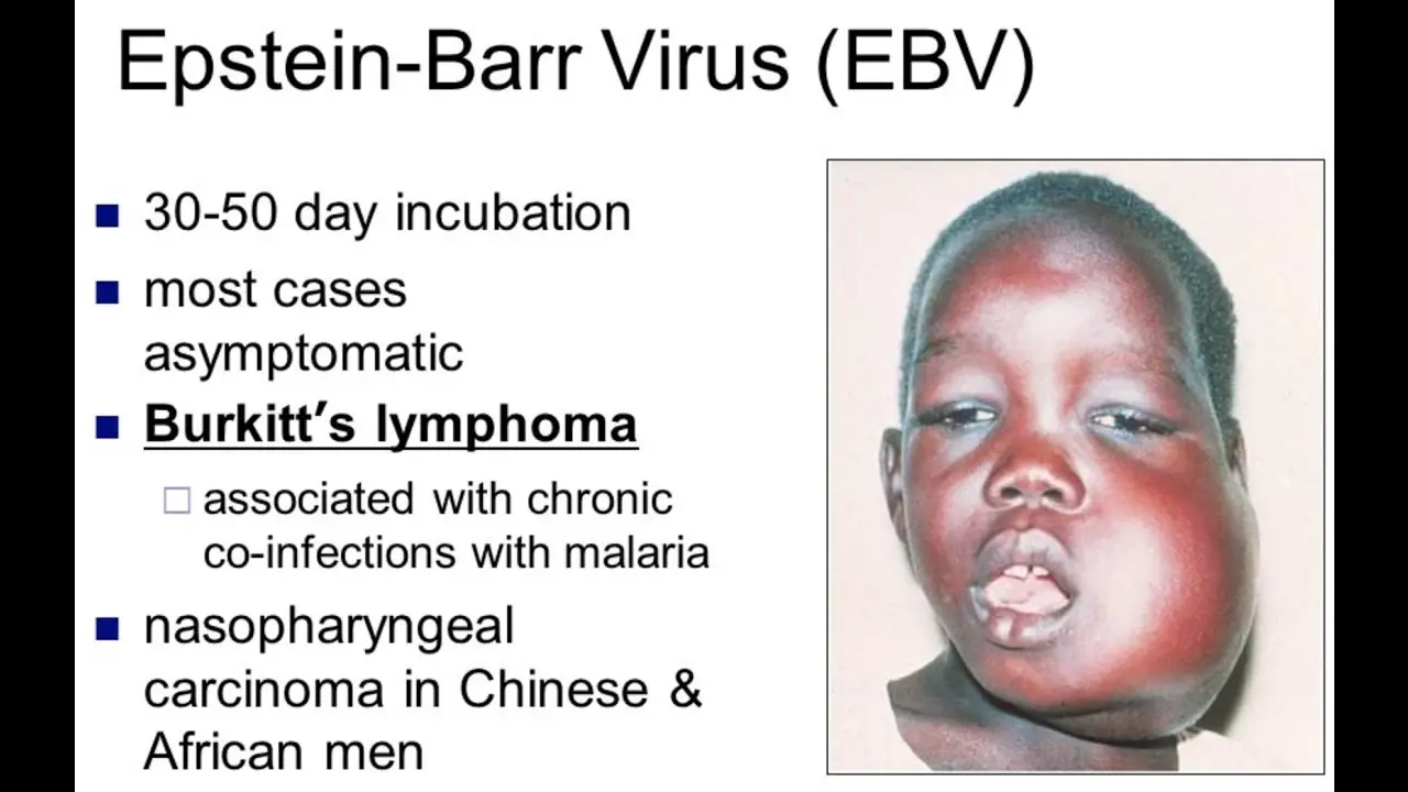 Burkitt&#8217;s Lymphoma &#8211; Symptoms and Treatment of Malignant Neoplasm