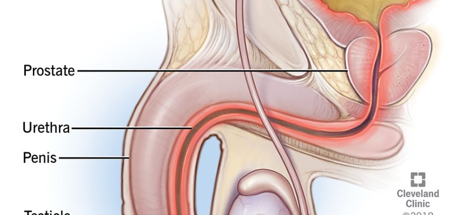 Burning sensation when urinating &#8211; is it a symptom of a disease?