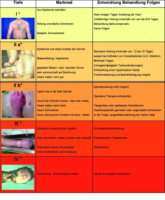 Burns &#8211; classification and symptoms. What to do in case of burns?