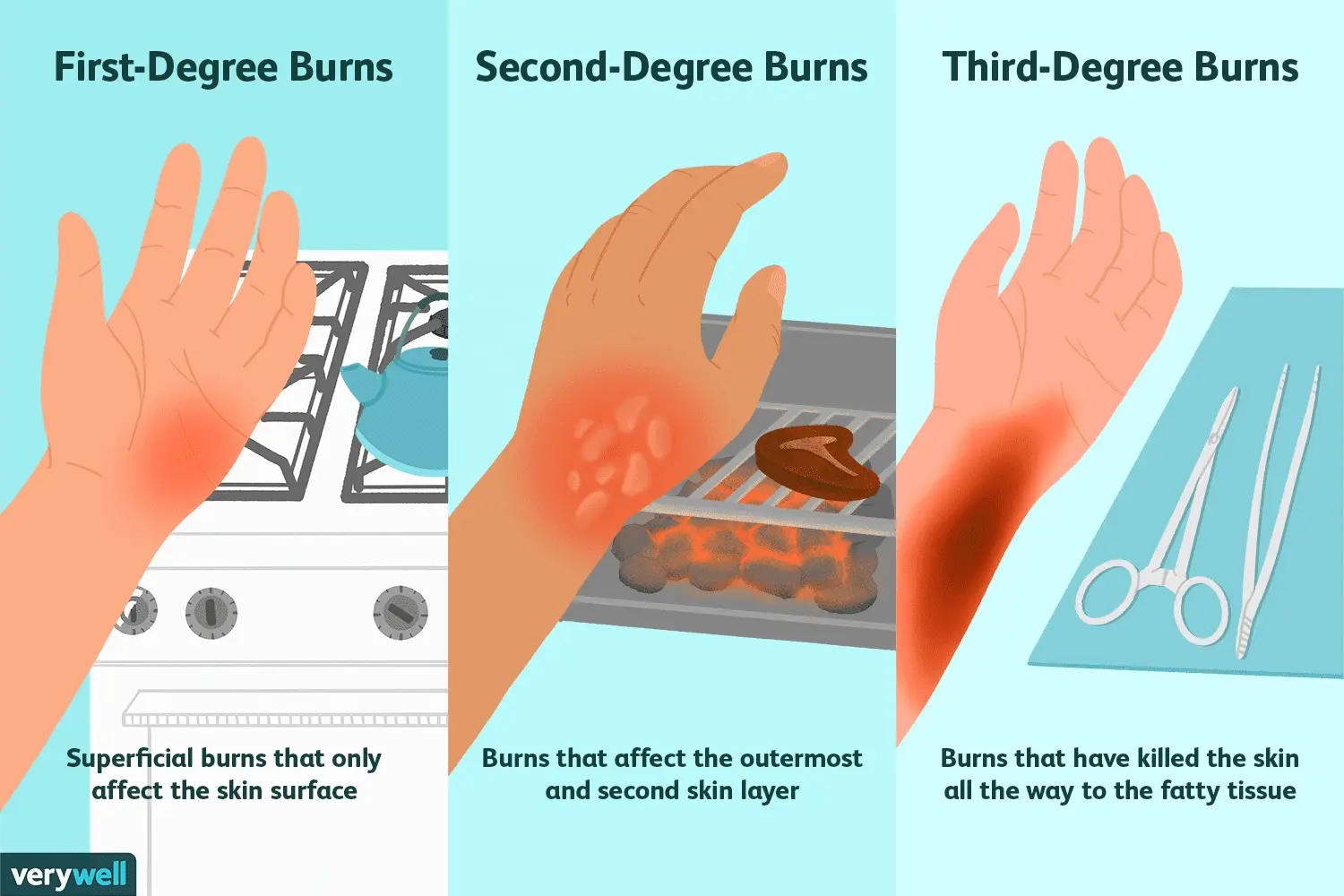 Burns &#8211; types, first aid, treatment. Preparations for burns