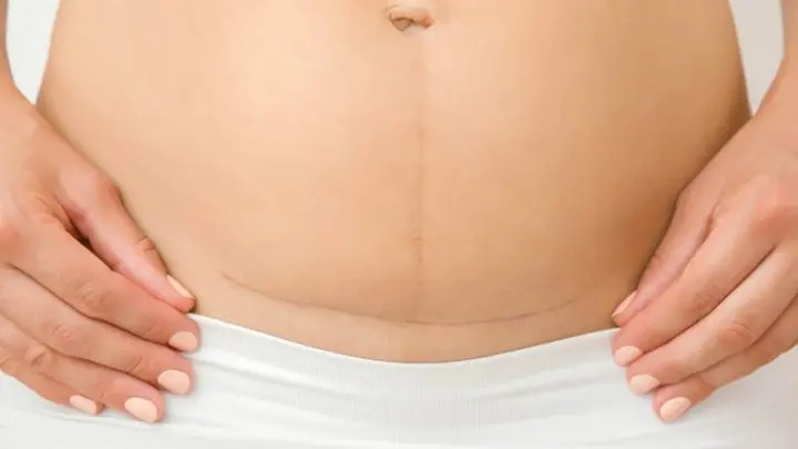 Caesarean scar &#8211; healing, hygiene, disturbing symptoms and complications. Cesarean scar removal