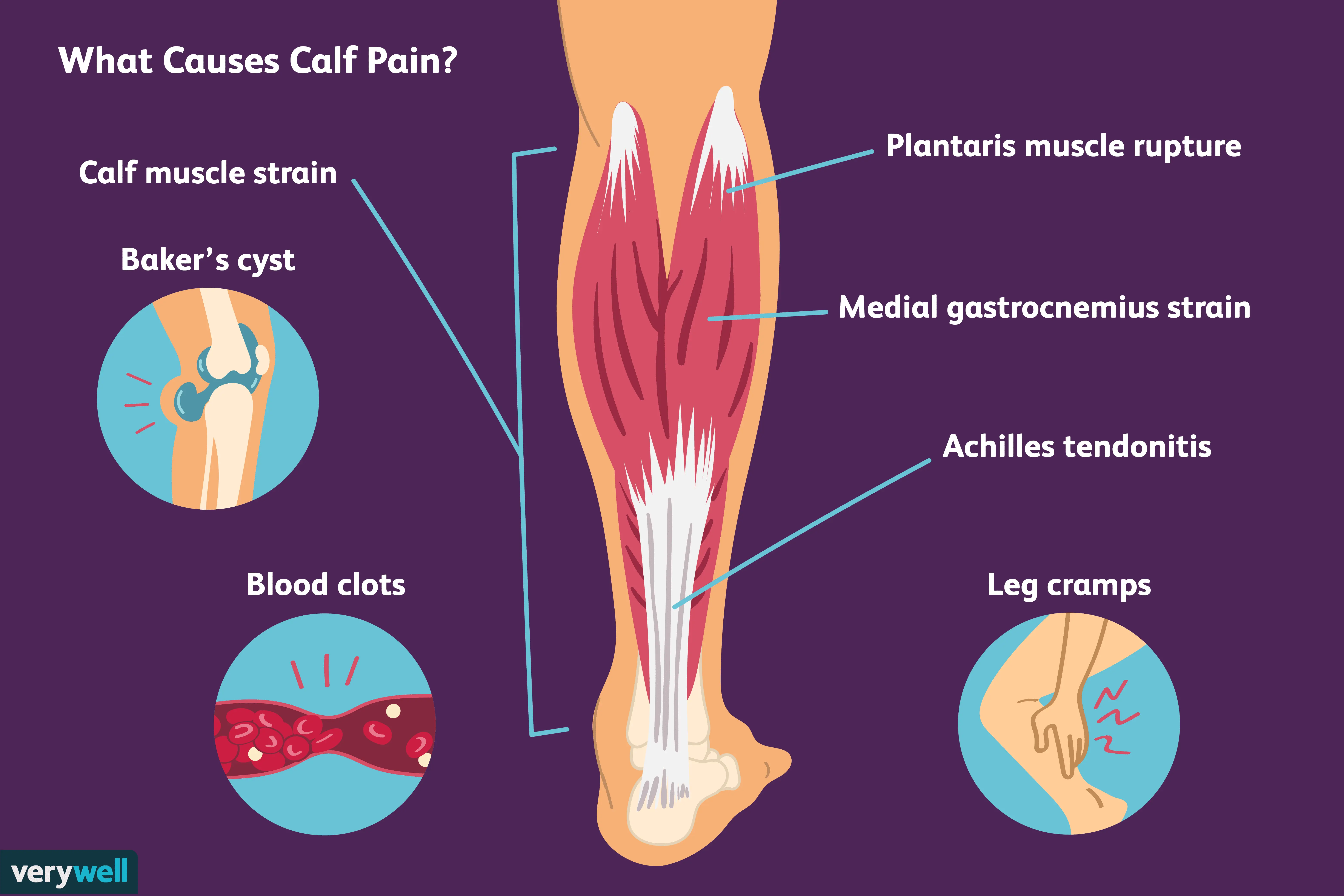 Calf cramps &#8211; what could they be a symptom of the disease?