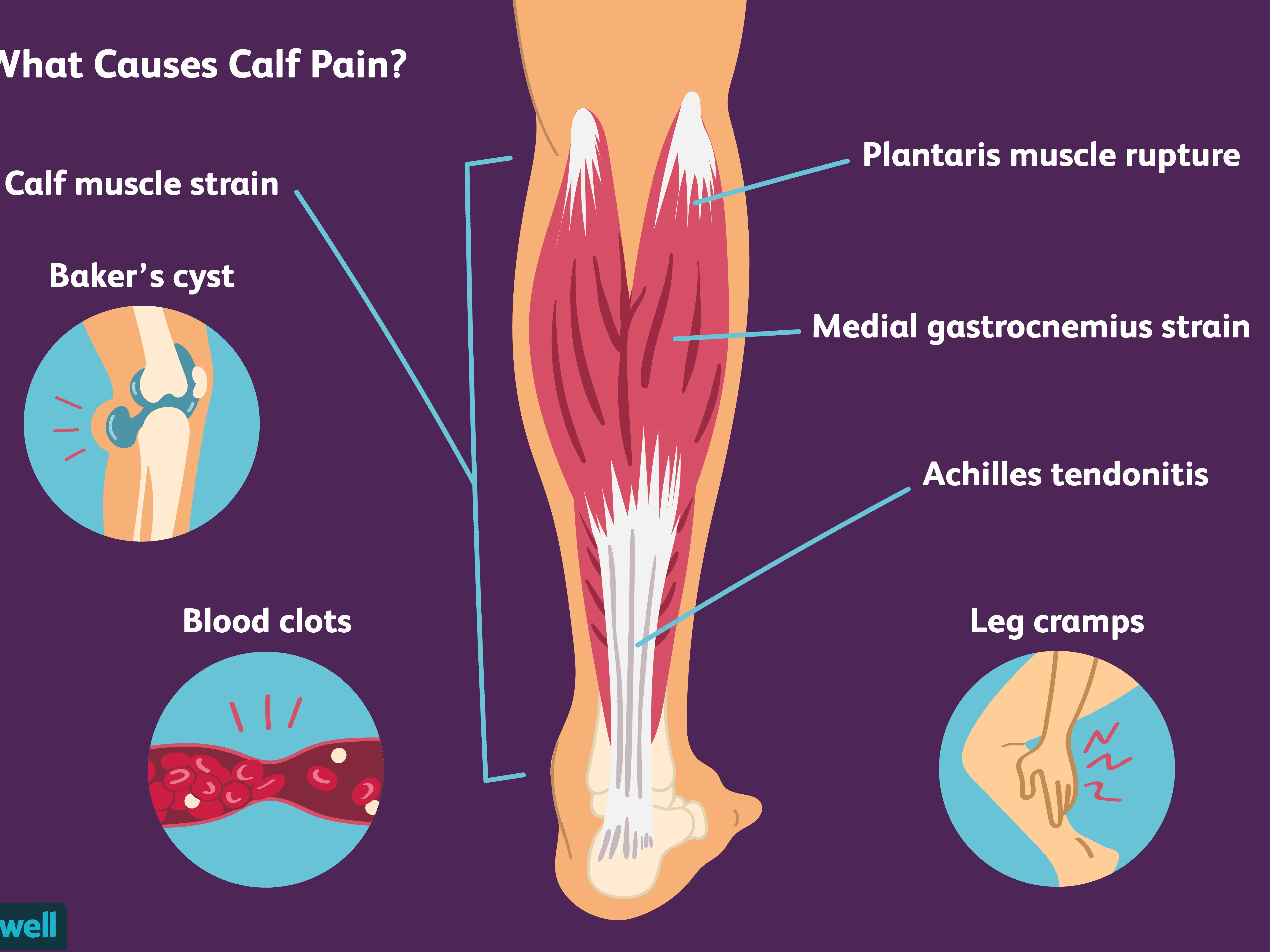 Calf pain &#8211; symptoms, causes, treatment, prognosis