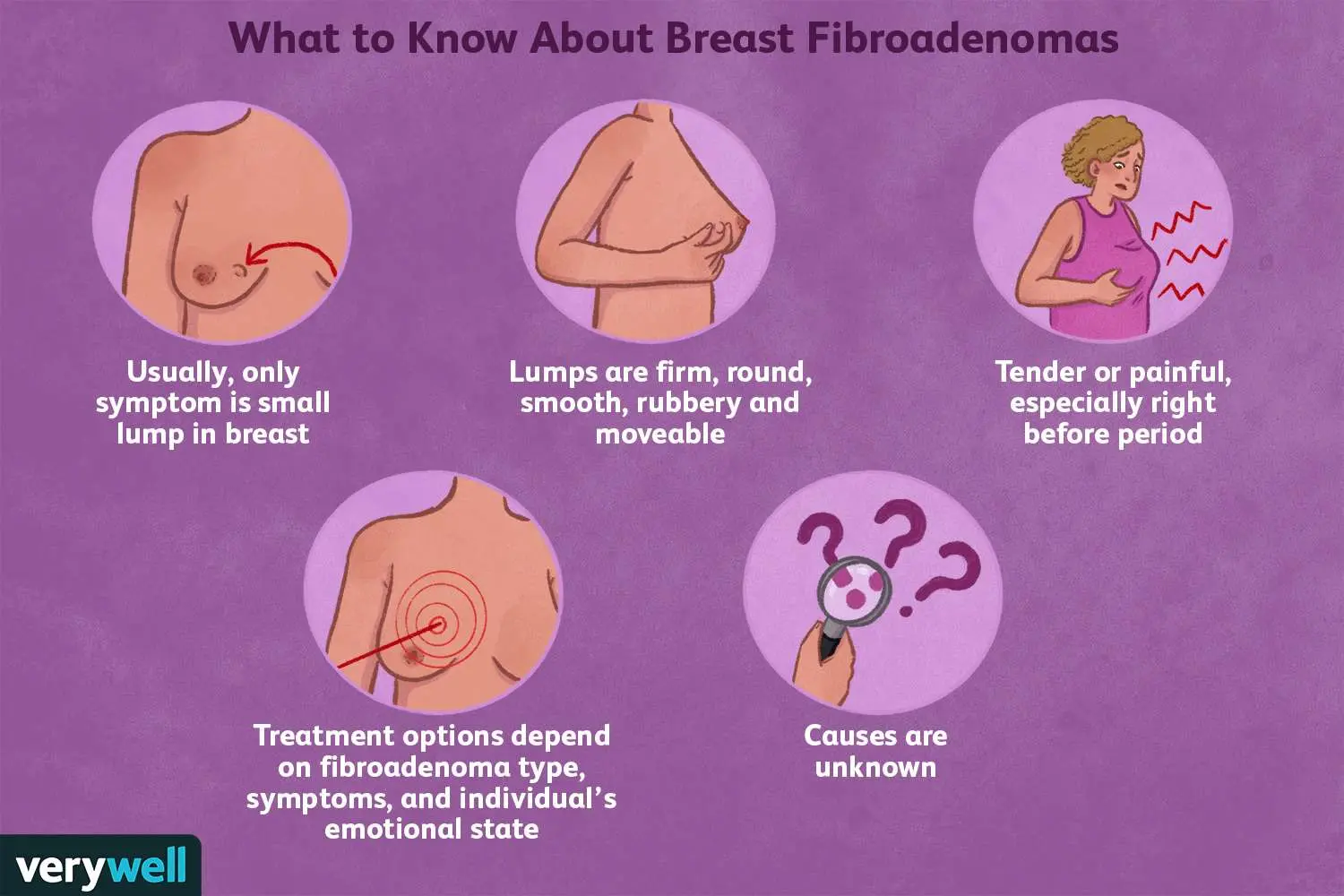 Can a breast fibroma be malignant?