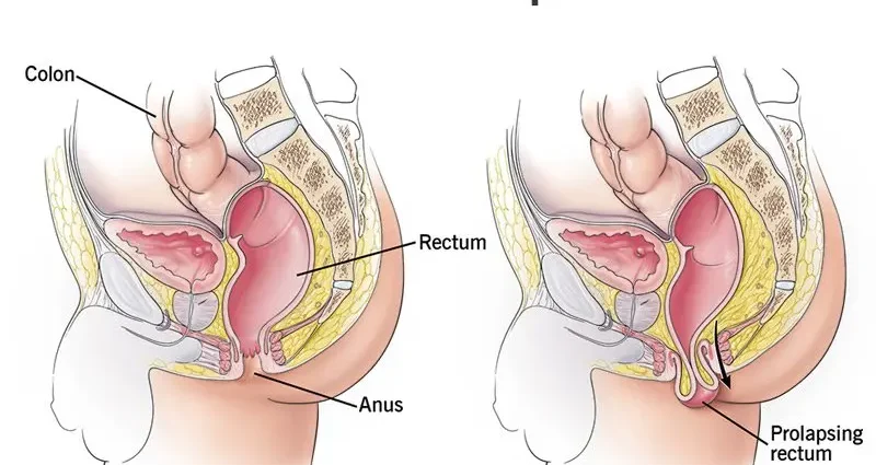 Can a prolapsed rectum be treated?