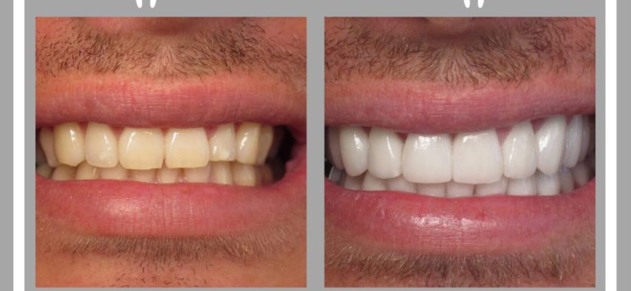 Can all teeth be whitened?