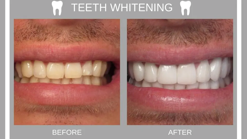 Can all teeth be whitened?