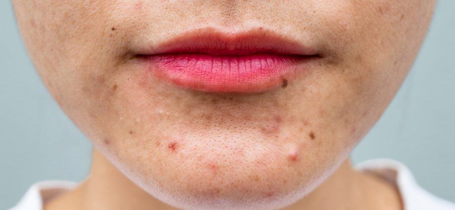 Can chin pimples be hormonal?