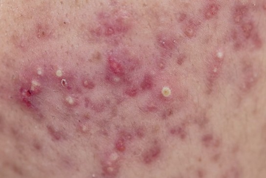 Can dust mites cause acne?