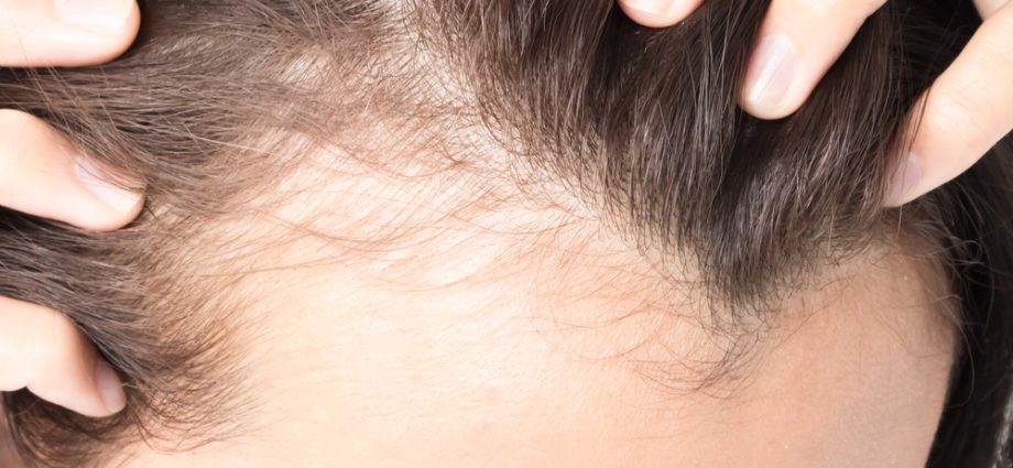 Can my hair hurt? Trichodynia is a real disease and a serious problem