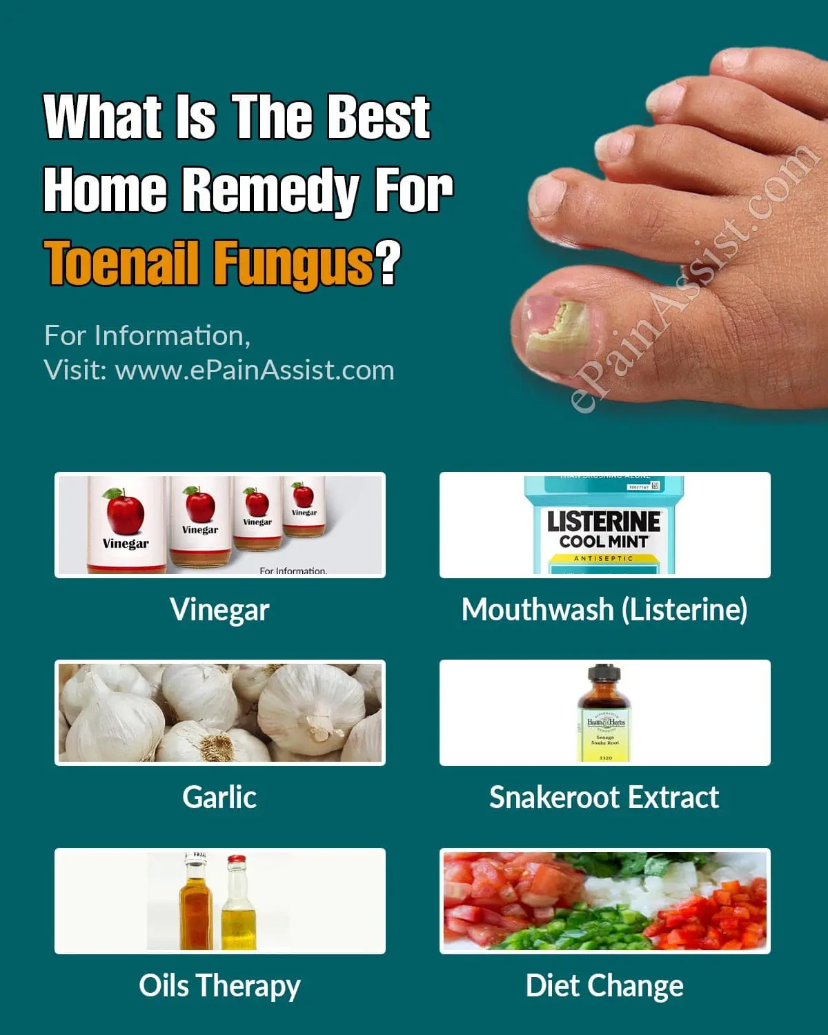 Can onychomycosis be treated with home remedies?