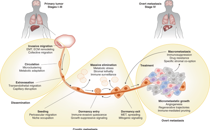 Cancer metastases to the bone &#8211; treatment, consequences